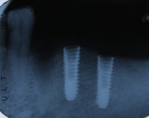 1B Dental implants X-ray