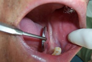 1A Dental implant Photo