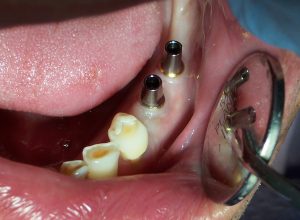 2A Dental implant abutments Photo