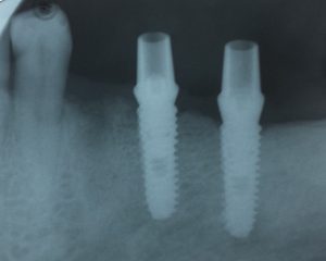 2B Dental implant abutments X-ray
