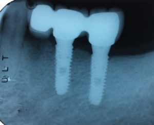 3B Dental implant Crowns X-ray