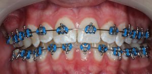 Braces - Metal Brackets