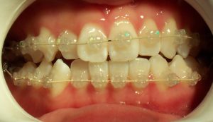 Braces - Tooth coloured brackets