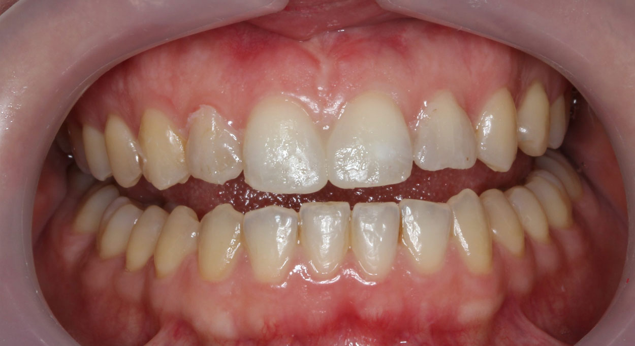 Cosmetic Dentistry Bonding Image After