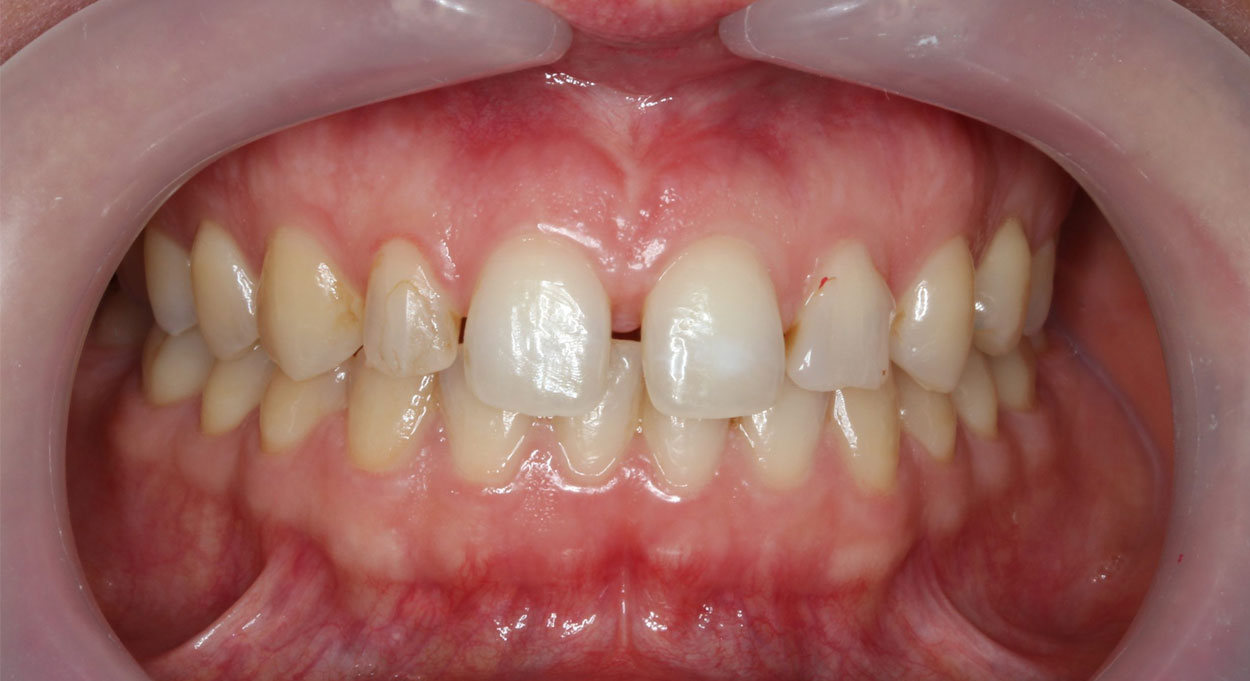 Cosmetic Dentistry Bonding Image Before