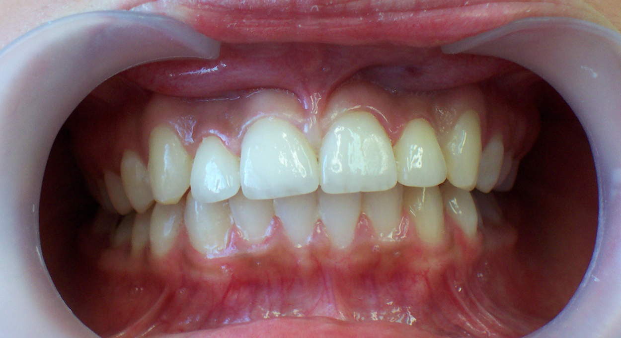 after-Porcelain-Veneers-Prosthodontics-Porcelain-crowns-final-result