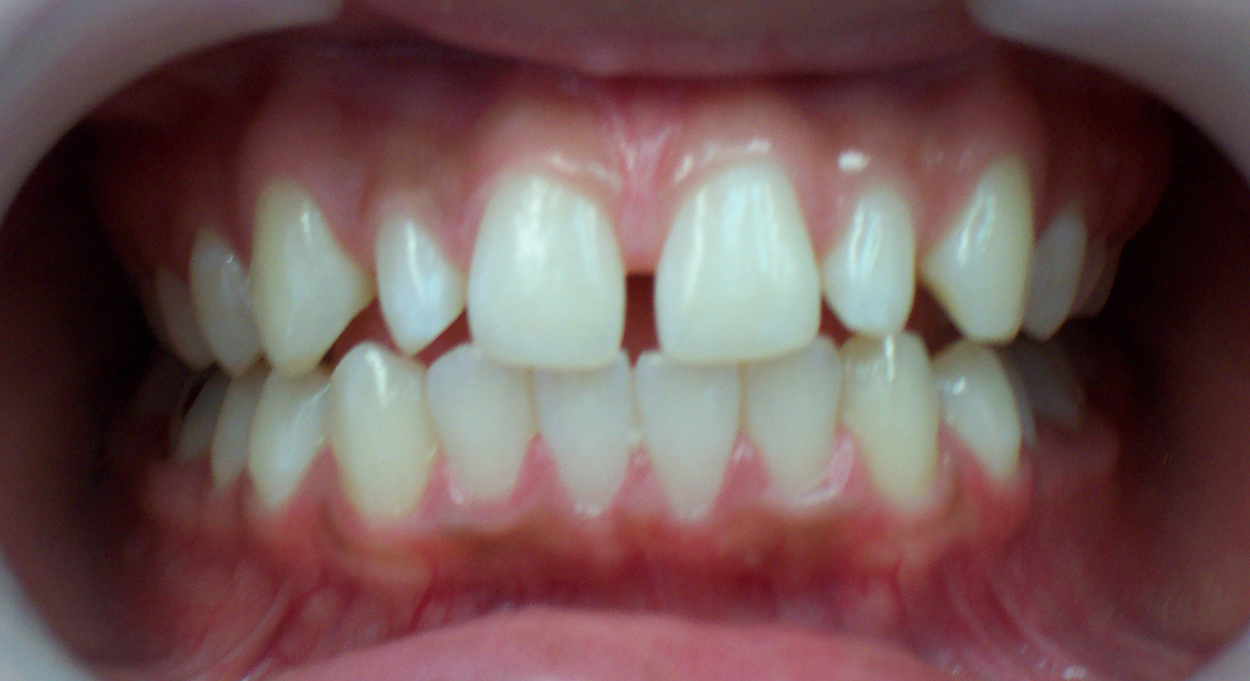 brfore-Porcelain-Veneers-Prosthodontics-Porcelain-Crowns-initial-photo