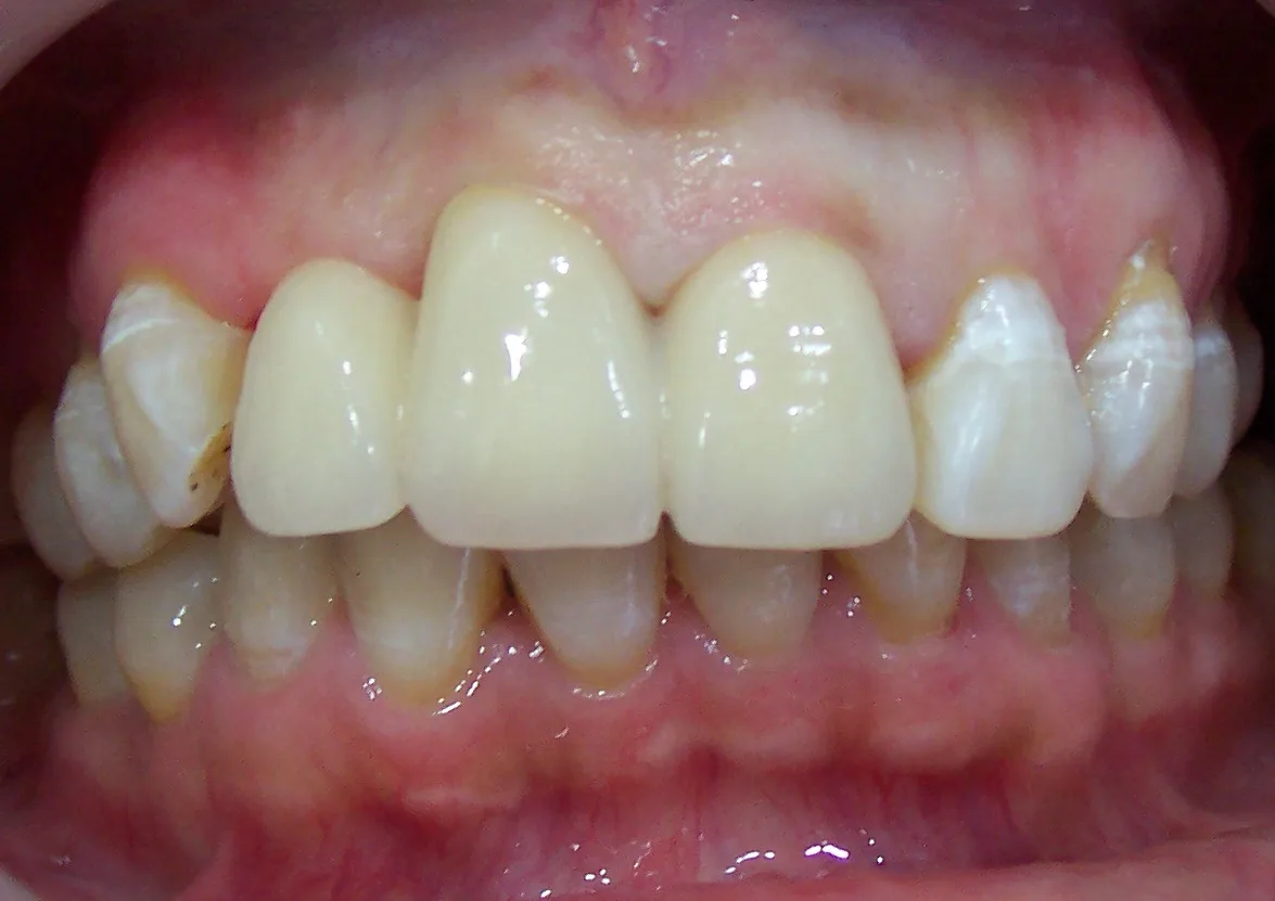 After image