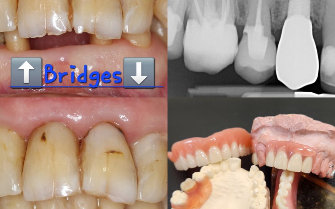 Missing a tooth? What are your options?