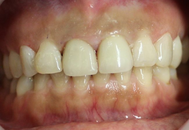 Anterior Crowns 1 – After