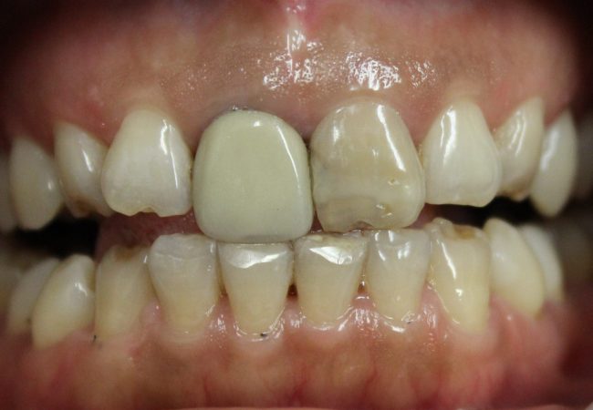 Anterior Crowns 1 – Before