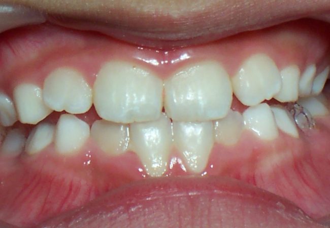 Cross Bite After