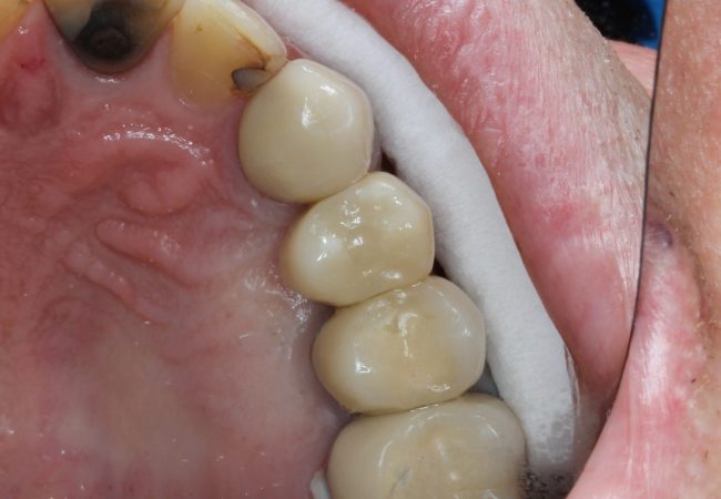 Dental Implant After