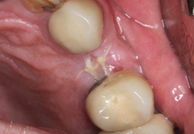 Dental Implant Before