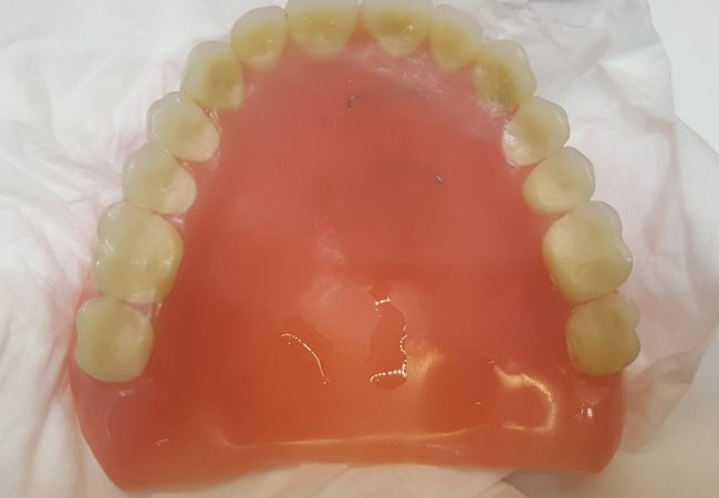 Denture Repair 1 – After