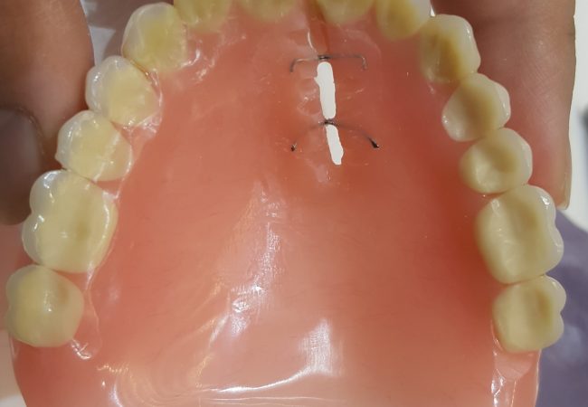 Denture Repair 1 – Before