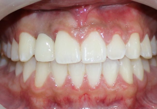 Implant And Braces After