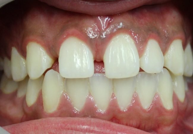 Implant And Braces Before