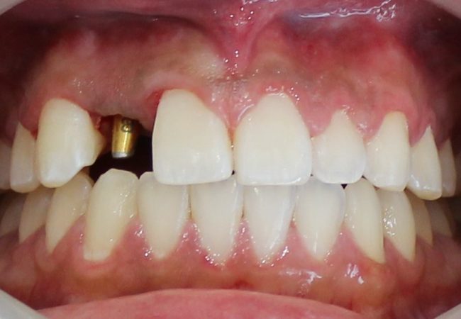 Implant And Braces During