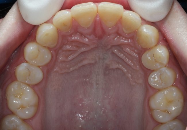 Invisalign After