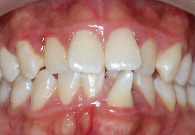 Ortho Case 1 – Before