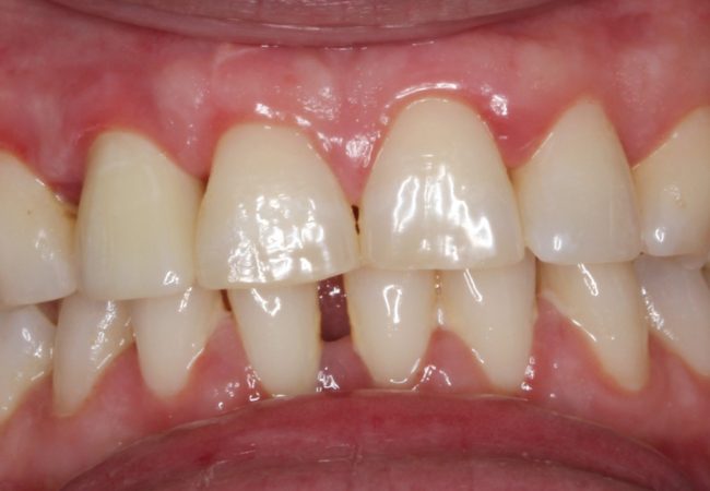 Dental Implant After