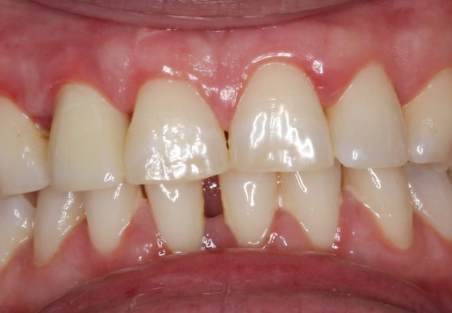 Dental Implant After