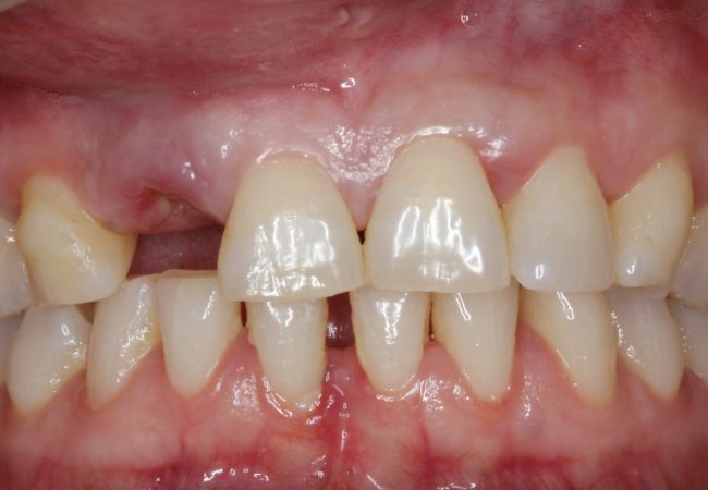 Dental Implant Before