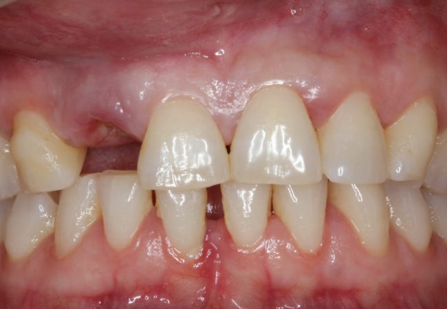 Dental Implant Before