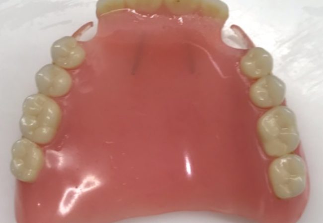 Denture Repair 2 – After