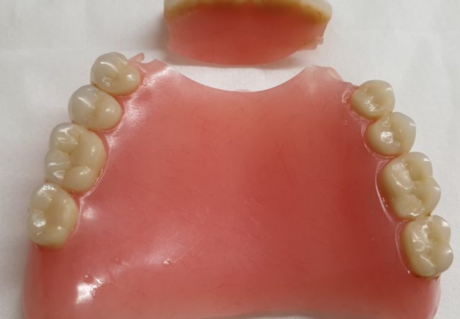 Denture Repair 2 – Before