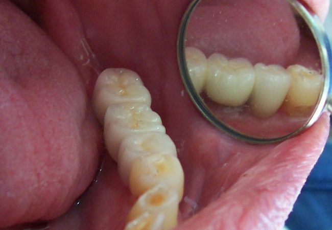 Dental Implant After