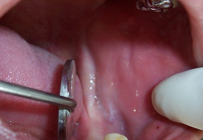 Dental Implant Before