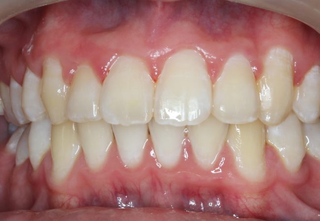 Ortho Case 2 – After