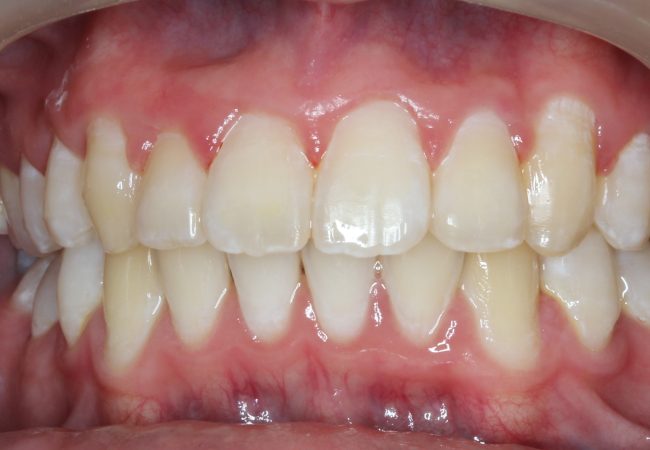 Ortho Case 2 – After
