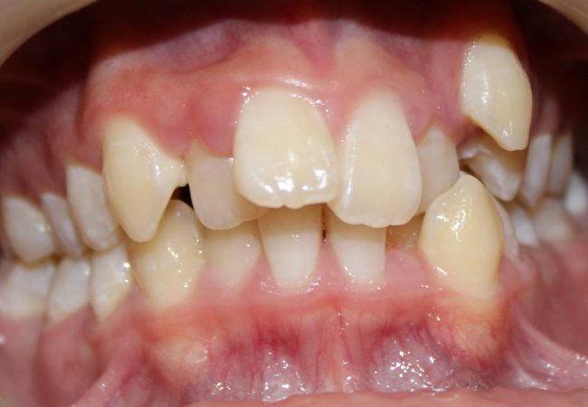 Ortho Case 2 – Before