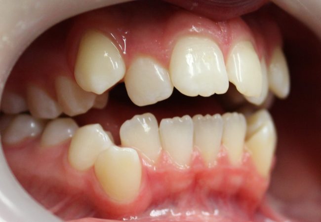 Ortho Case 3 – Before (Side)