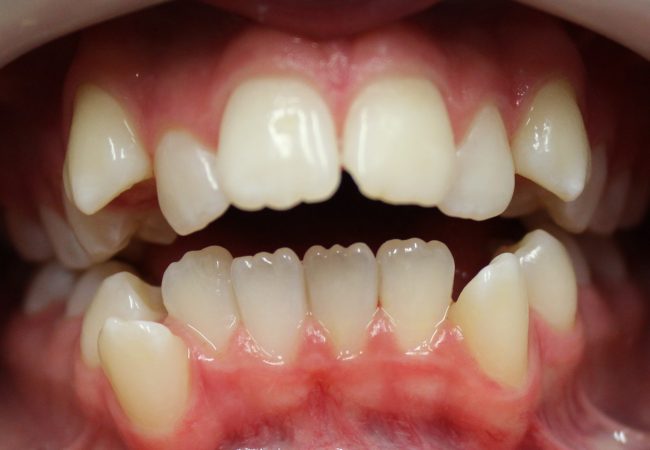 Ortho Case 3 – Before