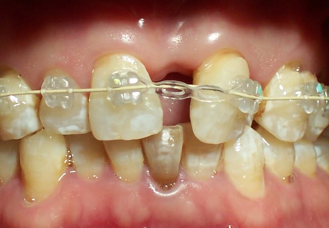 Ortho Case 4 – During