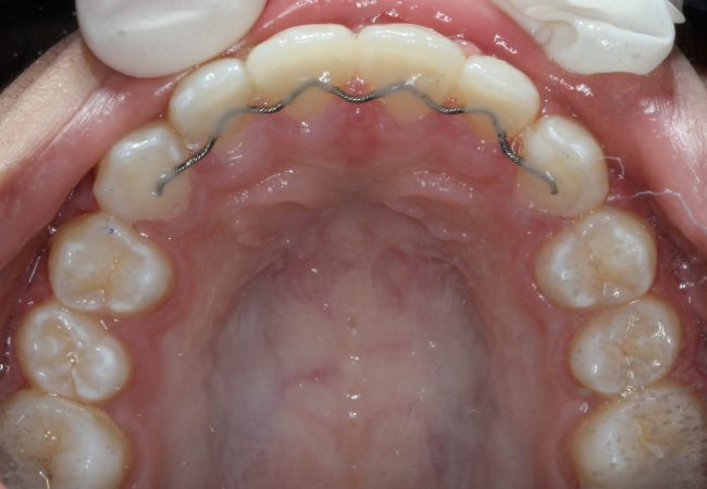 Ortho Case 5 – After