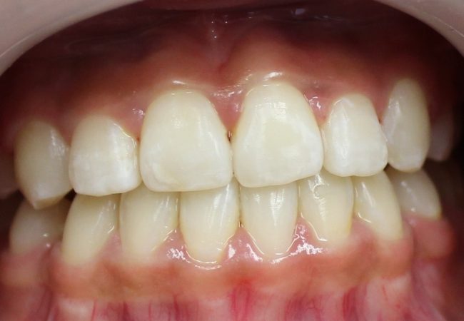Ortho Case 6 – After