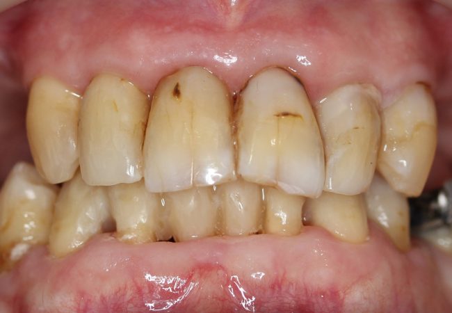 Anterior Composite Bridge After