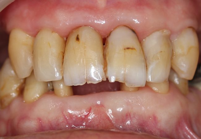 Anterior Composite Bridge Before