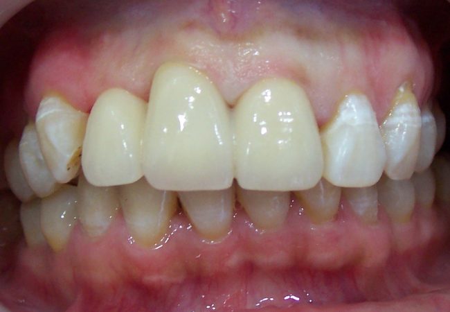 Anterior Crowns 2 – After