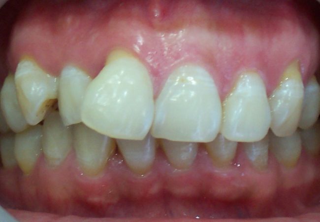 Anterior Crowns 2 – Before