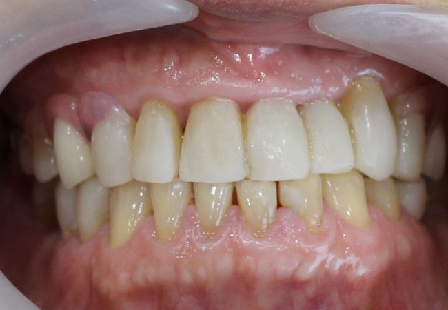 Underbite After Treatment