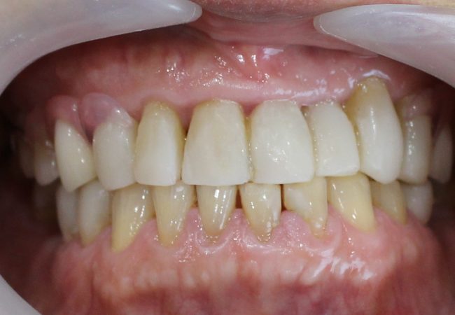 Underbite After Treatment