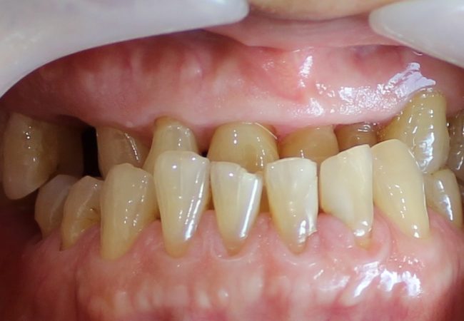 Underbite Before Treatment