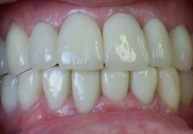 Crowns After