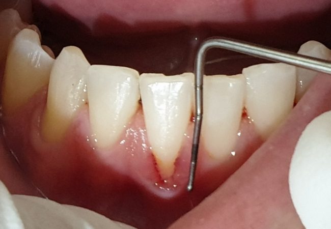 Gum recession and sensitivity